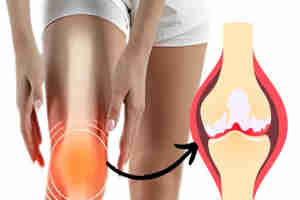Osteoarthritis of knee