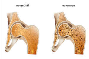 กระดูกพรุนในผู้สูงอายุ