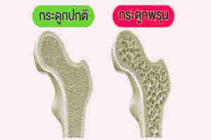 กระดูกพรุนมักไม่มีอาการมาก่อนมวลกระดูกผู้สูงอายุ
ป้องกันกระดูกพรุน